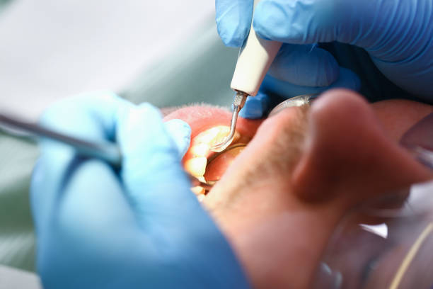 Best Emergency Tooth Extraction in Mojave, CA