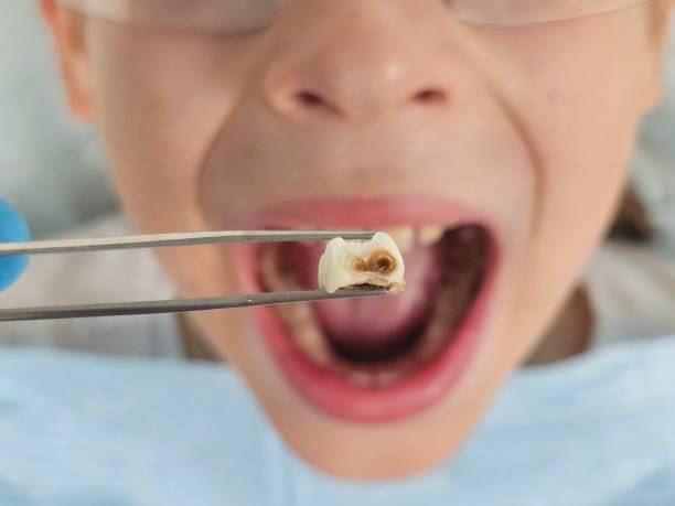 Best Emergency Tooth Extraction in Mojave, CA