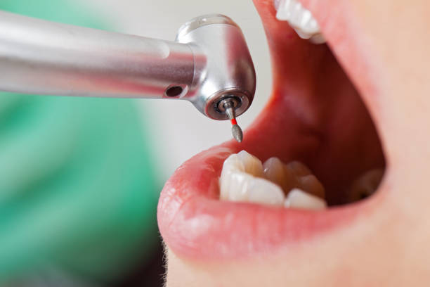 Best Emergency Wisdom Teeth Removal in Mojave, CA